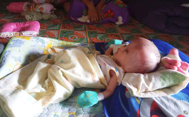 Bayi Hidrocepalus