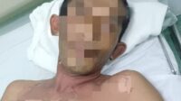 Korban yang menderita luka bakar akibat tersengat listrik