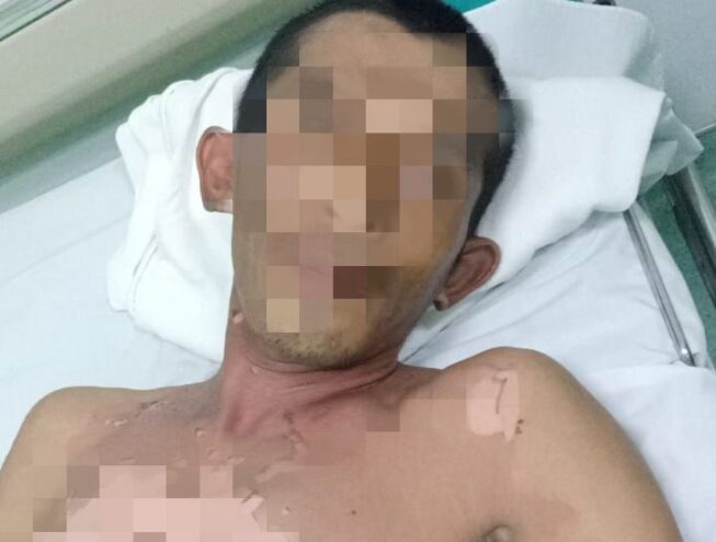 Korban yang menderita luka bakar akibat tersengat listrik Korban yang menderita luka bakar akibat tersengat listrik
